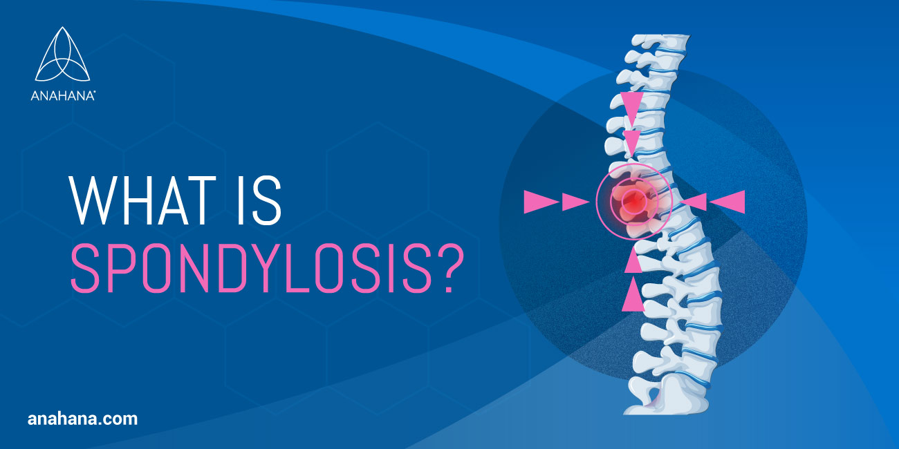 wat is Spondylose