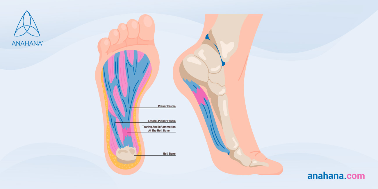 Plantaris fasciitis magyarázat