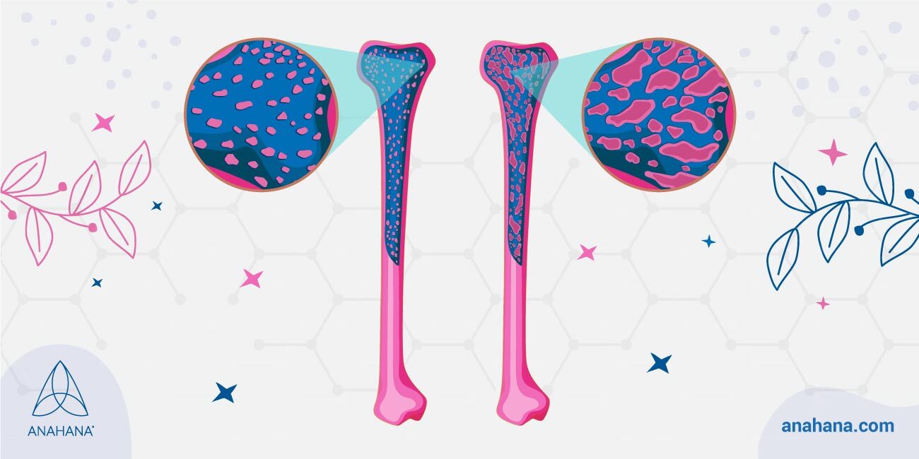 การรักษาต่างๆ สำหรับโรคกระดูกพรุน